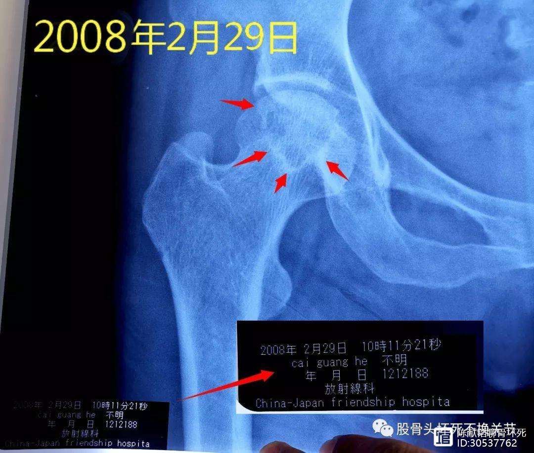 北京人工骨头医保报销多少(人工骨头医保报销多少比例)